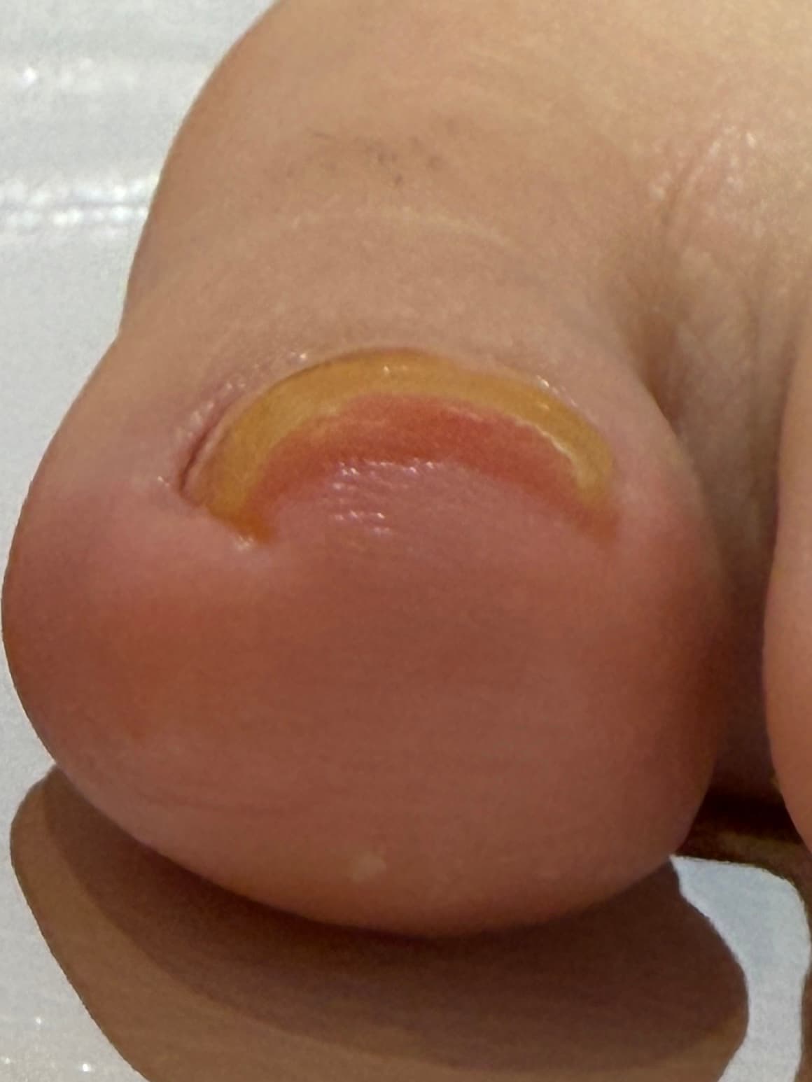 巻き爪ケア After