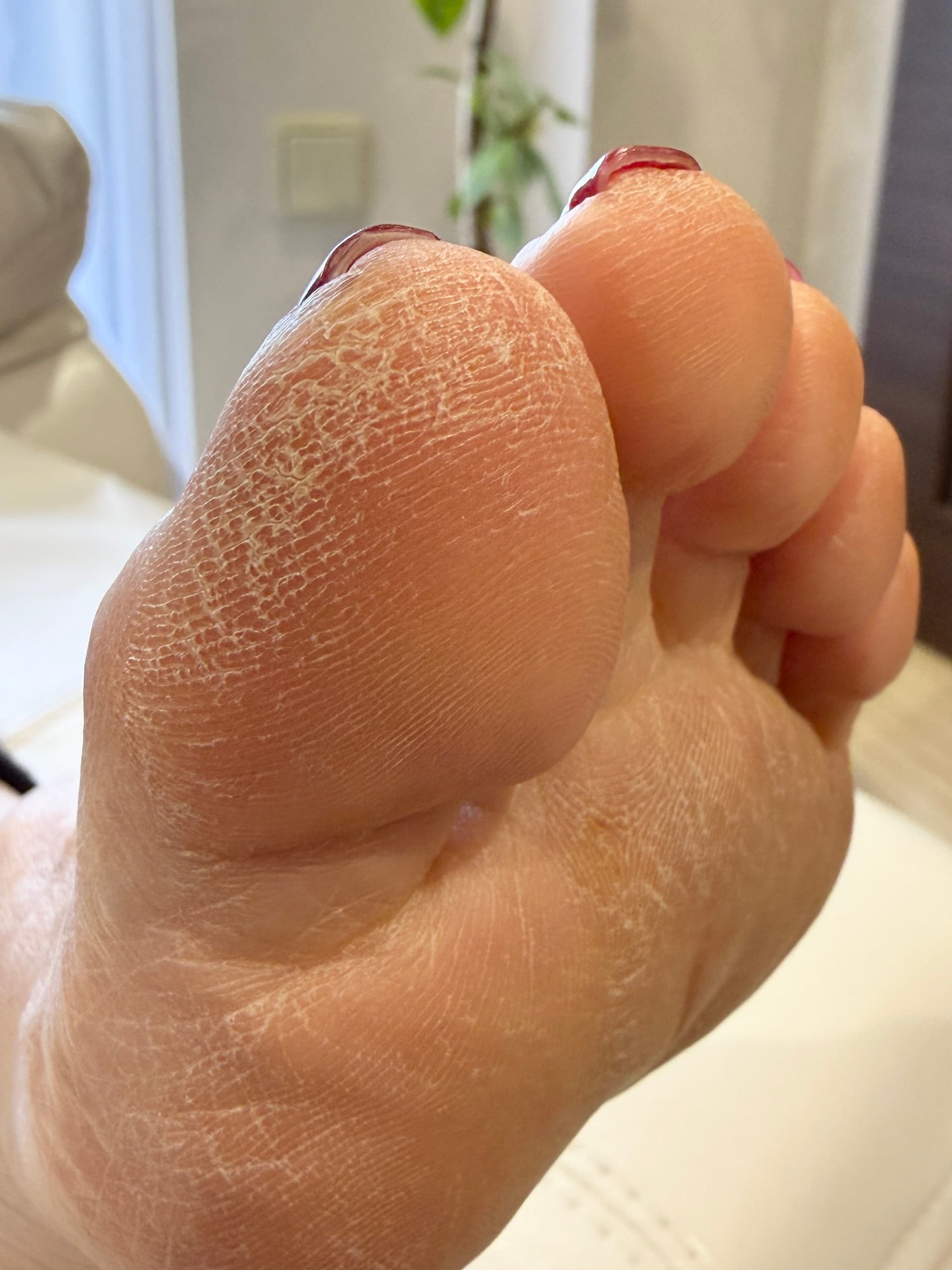 足裏角質ケア Before