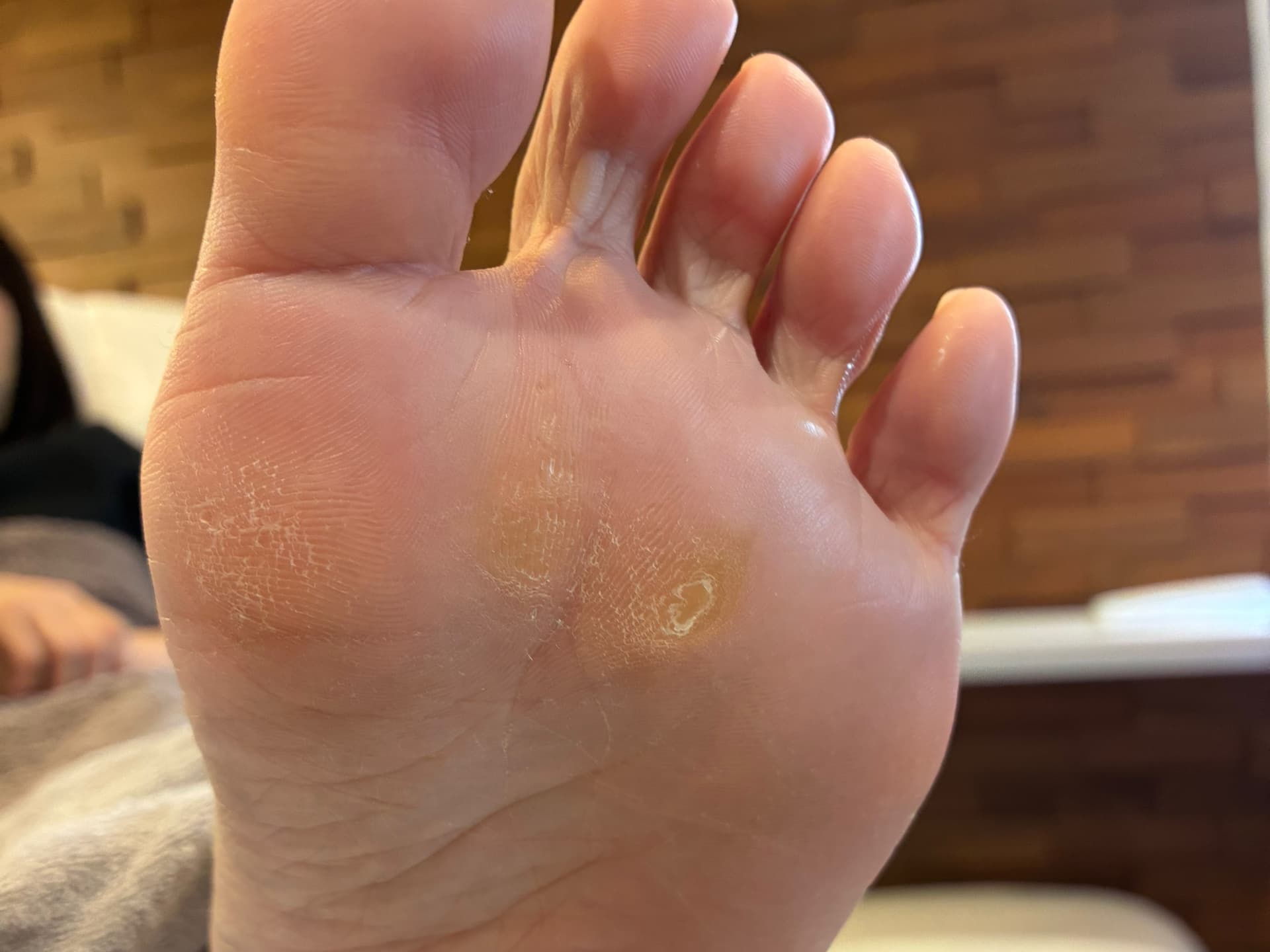 足裏角質ケア Before