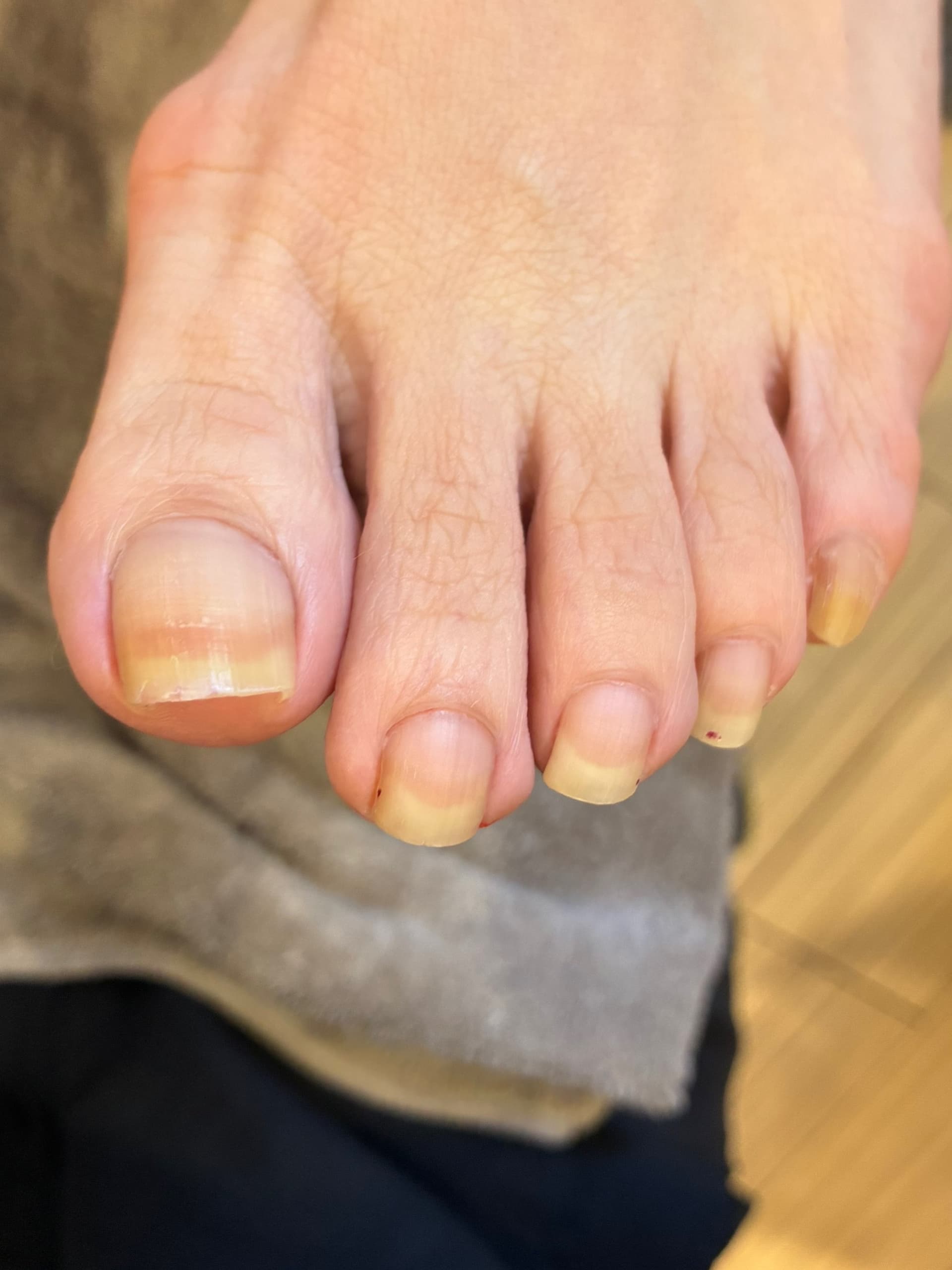 足爪ケア Before